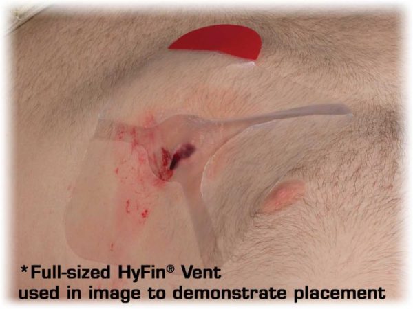 NAR hyfin chest seal in use